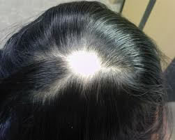 Alopecia areata